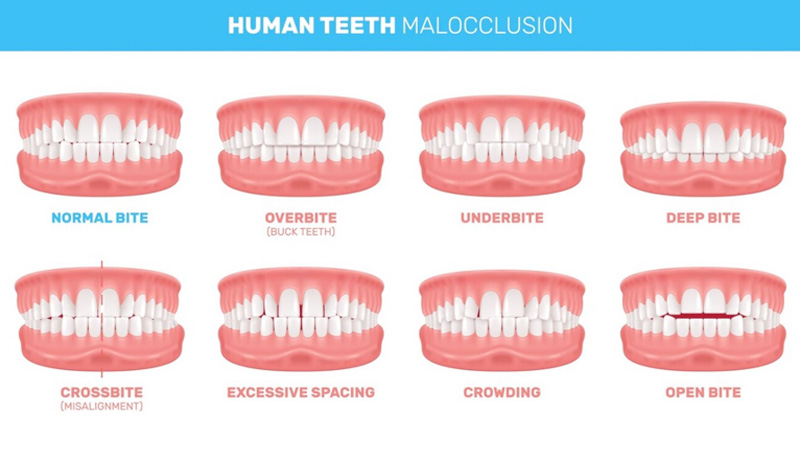 Clear Aligners address bite and jaw alignment issues