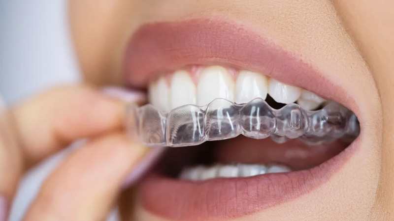  From consultation to the retention phase, Thes smile spa ensure a smooth and comfortable experience transforming lives with Clear aligners, such as Invisalign