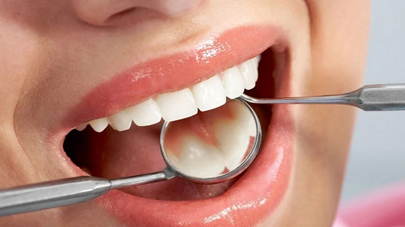 benefits of front tooth fillings